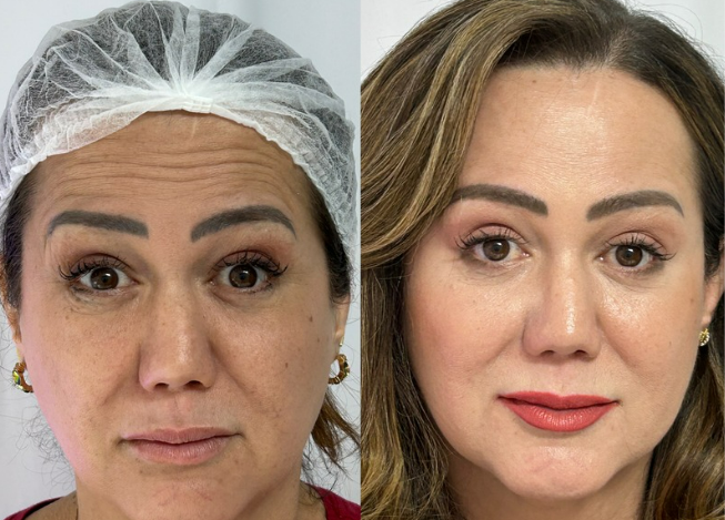 botox01