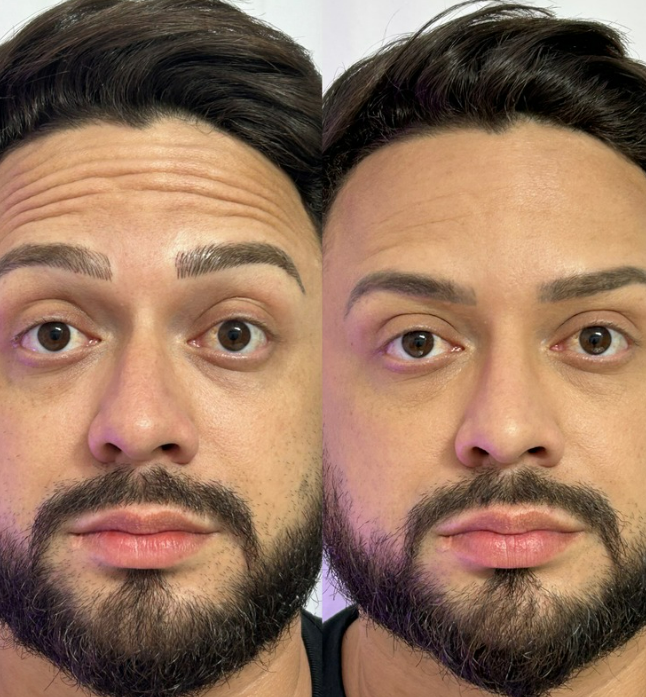 botox02