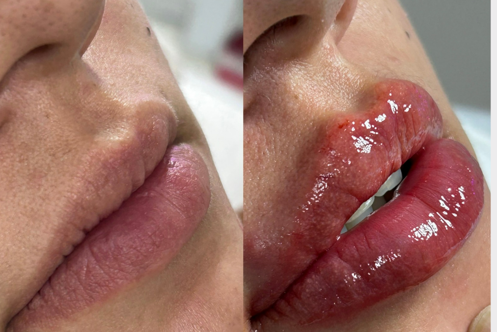 labial01